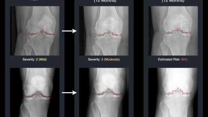 images showing how the new AI tech will improve knee health predictions