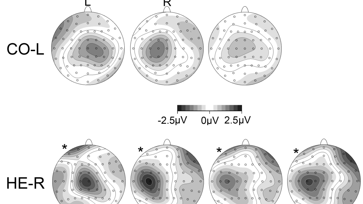 EEG, Hemiparesis & Motor Planning